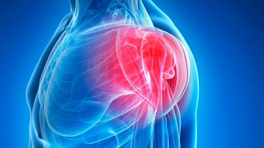 Reverse shoulder replacement procedure for shoulder pain relief