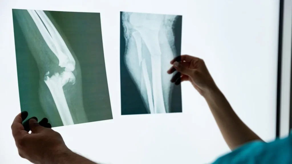 Two X-rays of fractured leg bones being held by a medical professional.